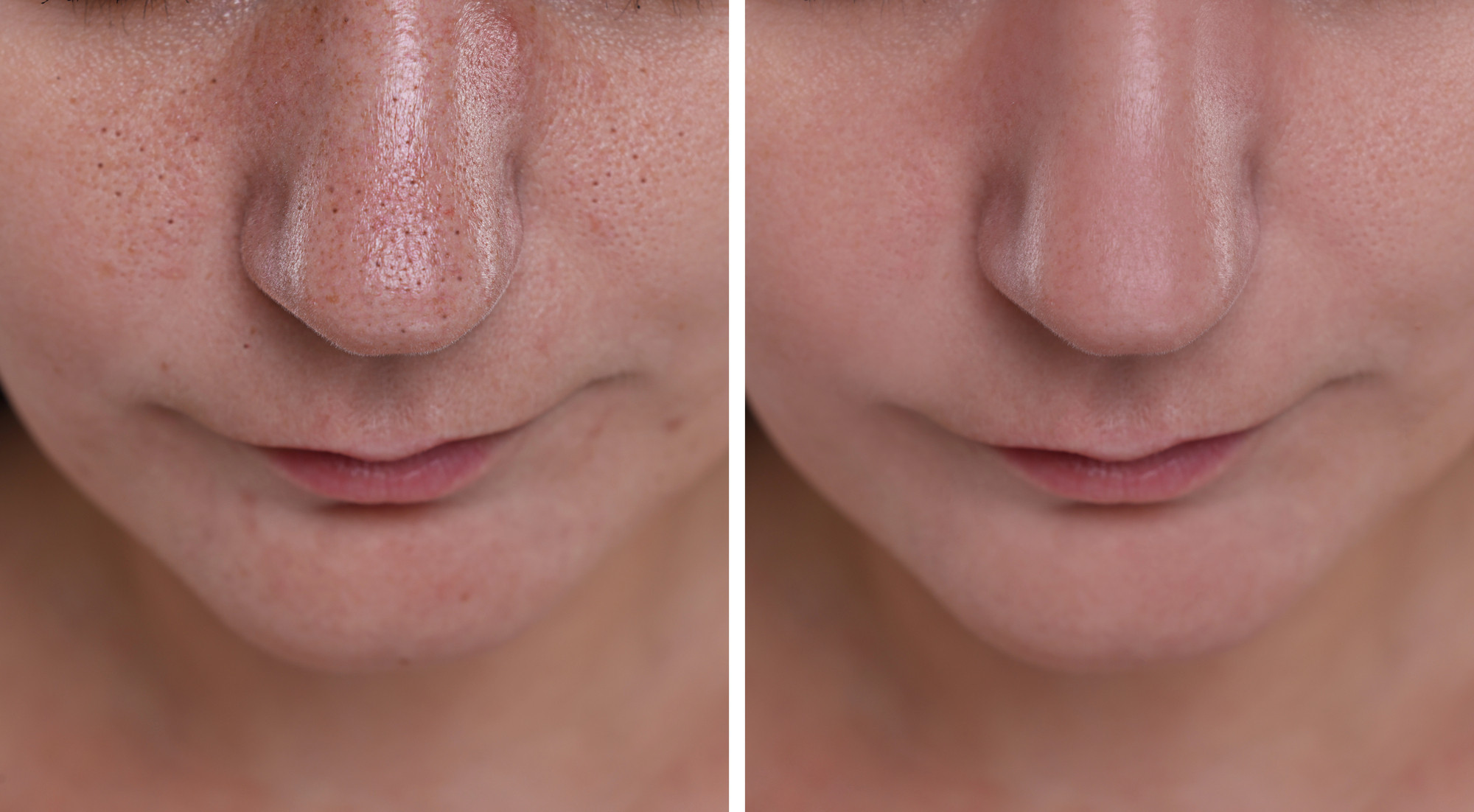 Чорні точки на обличчі